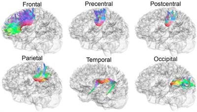 The neurocognitive correlates of DTI indicators of white matter disorganization in pediatric moderate-to-severe traumatic brain injury